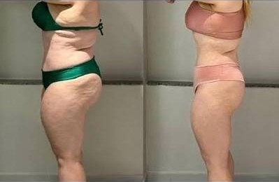 Antes e depois — Patrícia R.
